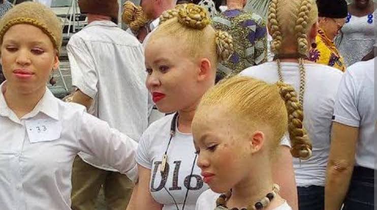 Bayelsa Albinism Community in Crisis as Skin Cancer Cases Soar